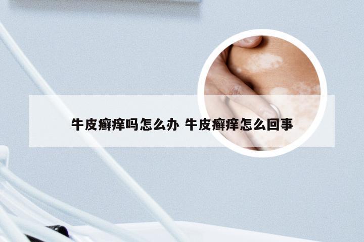 牛皮癣痒吗怎么办 牛皮癣痒怎么回事