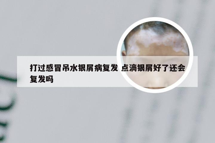 打过感冒吊水银屑病复发 点滴银屑好了还会复发吗