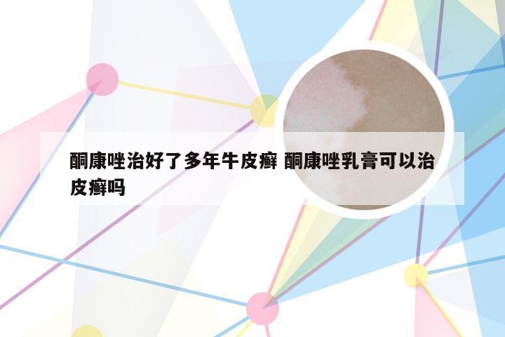 酮康唑治好了多年牛皮癣 酮康唑乳膏可以治皮癣吗