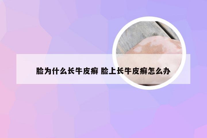 脸为什么长牛皮癣 脸上长牛皮癣怎么办