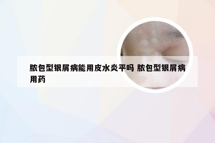 脓包型银屑病能用皮水炎平吗 脓包型银屑病用药