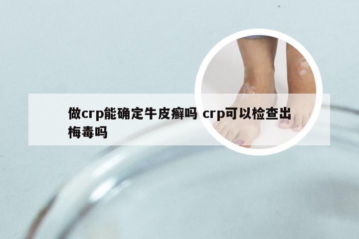 做crp能确定牛皮癣吗 crp可以检查出梅毒吗