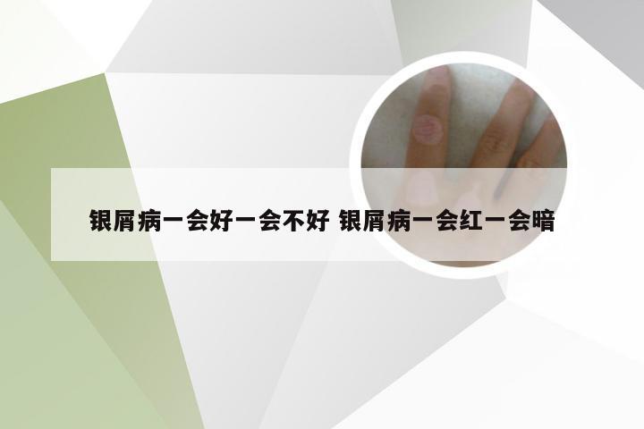 银屑病一会好一会不好 银屑病一会红一会暗