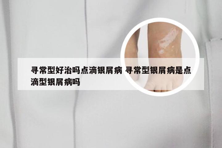 寻常型好治吗点滴银屑病 寻常型银屑病是点滴型银屑病吗