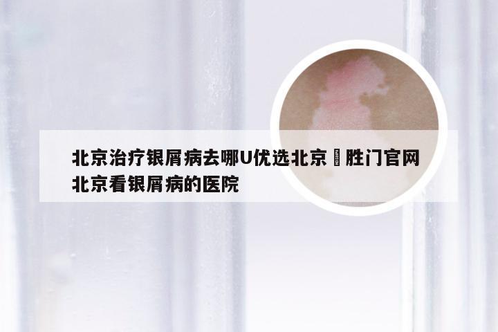 北京治疗银屑病去哪U优选北京徳胜门官网 北京看银屑病的医院