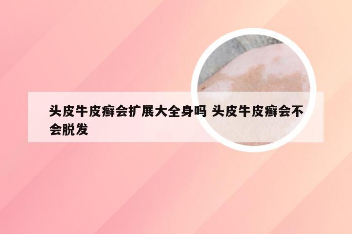 头皮牛皮癣会扩展大全身吗 头皮牛皮癣会不会脱发