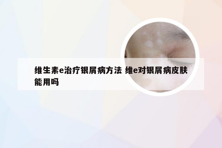 维生素e治疗银屑病方法 维e对银屑病皮肤能用吗