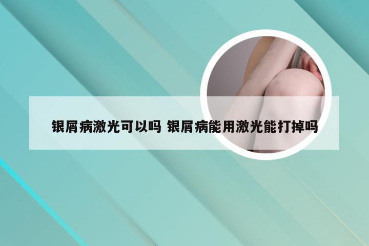 银屑病激光可以吗 银屑病能用激光能打掉吗