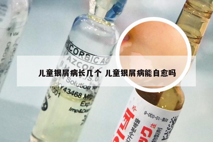 儿童银屑病长几个 儿童银屑病能自愈吗
