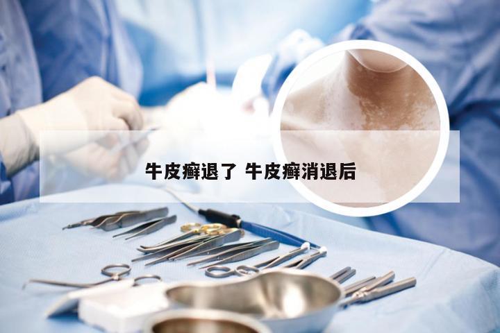 牛皮癣退了 牛皮癣消退后