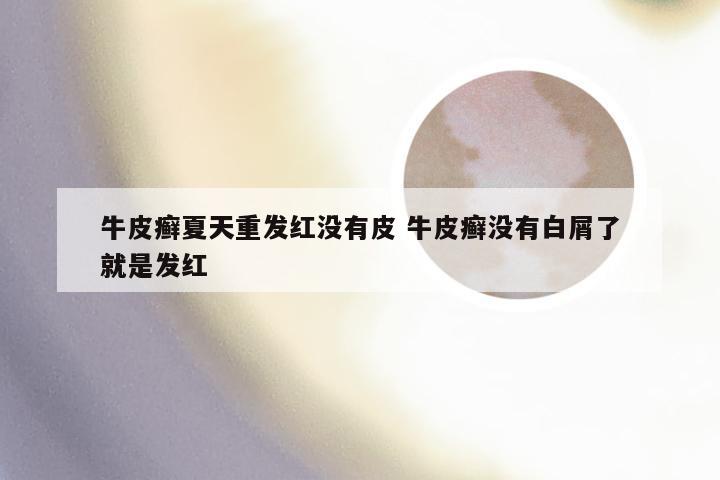 牛皮癣夏天重发红没有皮 牛皮癣没有白屑了就是发红