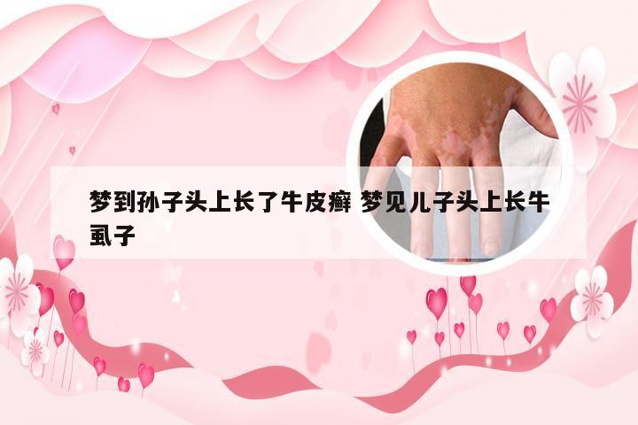 梦到孙子头上长了牛皮癣 梦见儿子头上长牛虱子