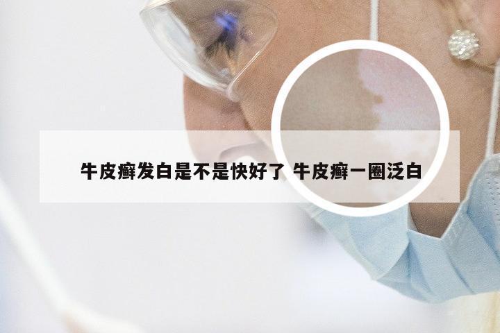 牛皮癣发白是不是快好了 牛皮癣一圈泛白