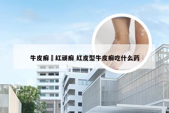 牛皮癣蔵红顽癣 红皮型牛皮癣吃什么药