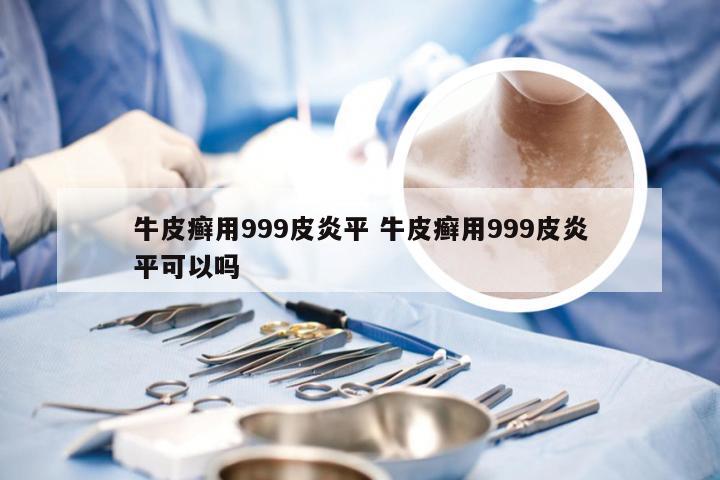 牛皮癣用999皮炎平 牛皮癣用999皮炎平可以吗