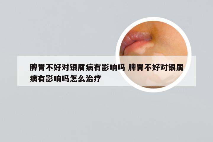 脾胃不好对银屑病有影响吗 脾胃不好对银屑病有影响吗怎么治疗