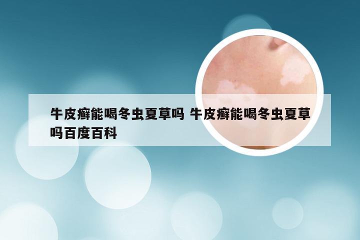 牛皮癣能喝冬虫夏草吗 牛皮癣能喝冬虫夏草吗百度百科