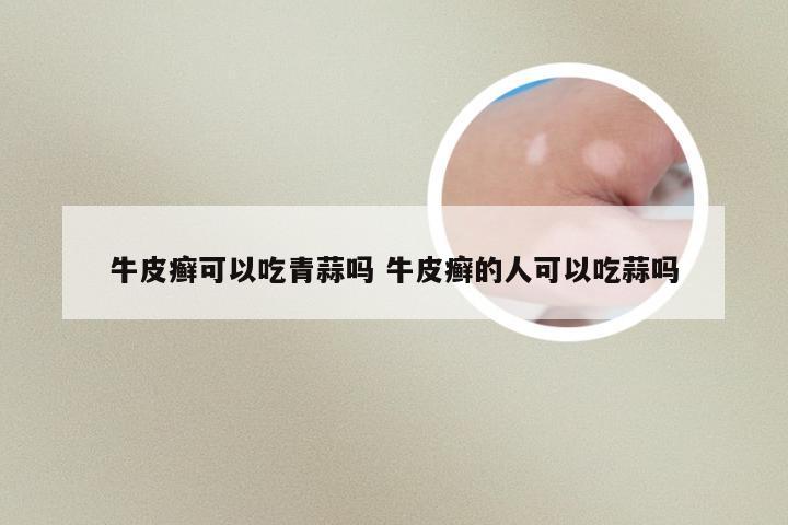 牛皮癣可以吃青蒜吗 牛皮癣的人可以吃蒜吗