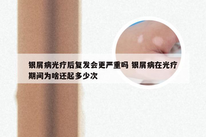 银屑病光疗后复发会更严重吗 银屑病在光疗期间为啥还起多少次