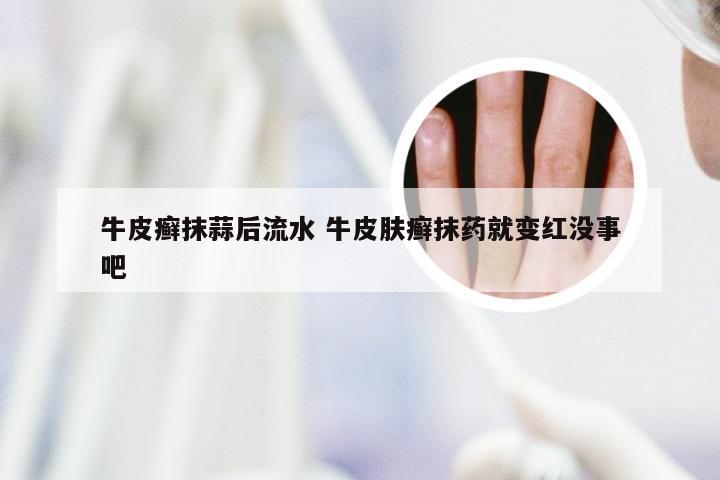 牛皮癣抹蒜后流水 牛皮肤癣抹药就变红没事吧