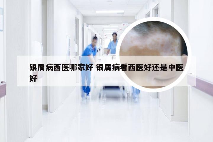 银屑病西医哪家好 银屑病看西医好还是中医好