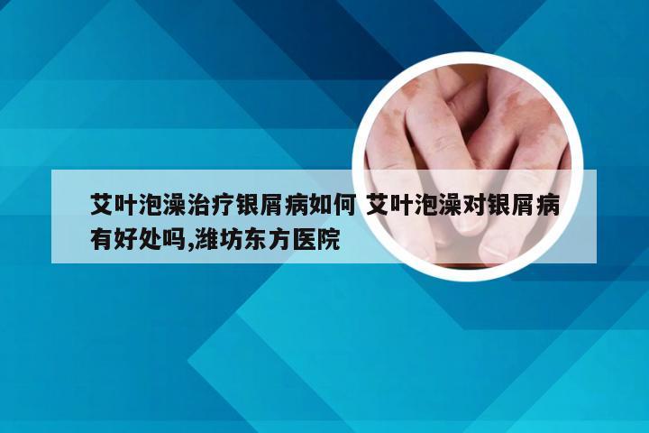艾叶泡澡治疗银屑病如何 艾叶泡澡对银屑病有好处吗,潍坊东方医院