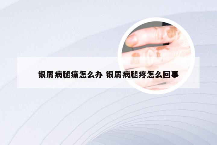 银屑病腿痛怎么办 银屑病腿疼怎么回事
