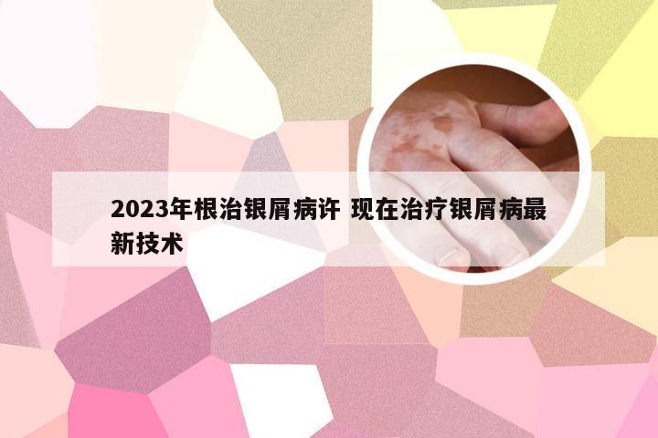 2023年根治银屑病许 现在治疗银屑病最新技术