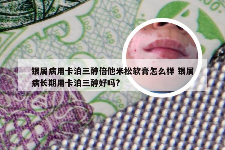 银屑病用卡泊三醇倍他米松软膏怎么样 银屑病长期用卡泊三醇好吗?