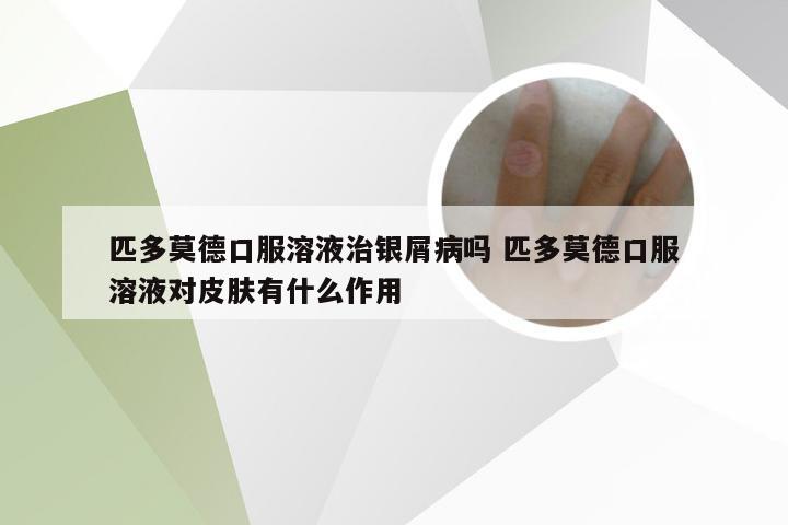 匹多莫德口服溶液治银屑病吗 匹多莫德口服溶液对皮肤有什么作用