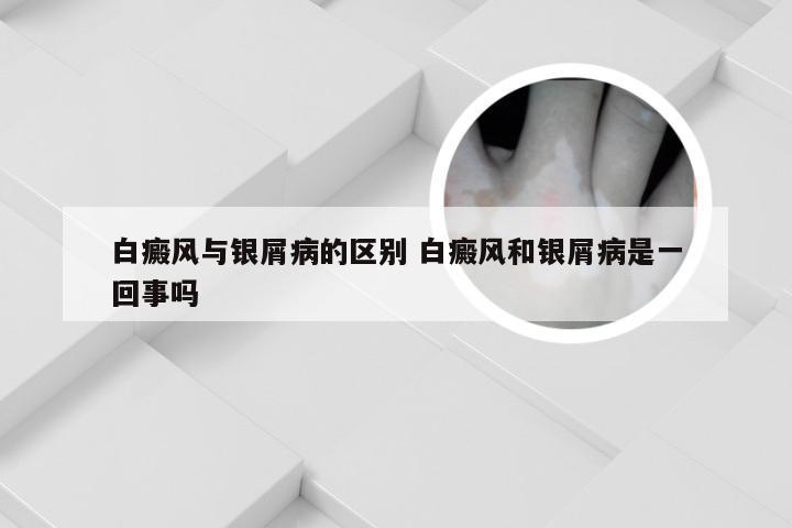 白癜风与银屑病的区别 白癜风和银屑病是一回事吗