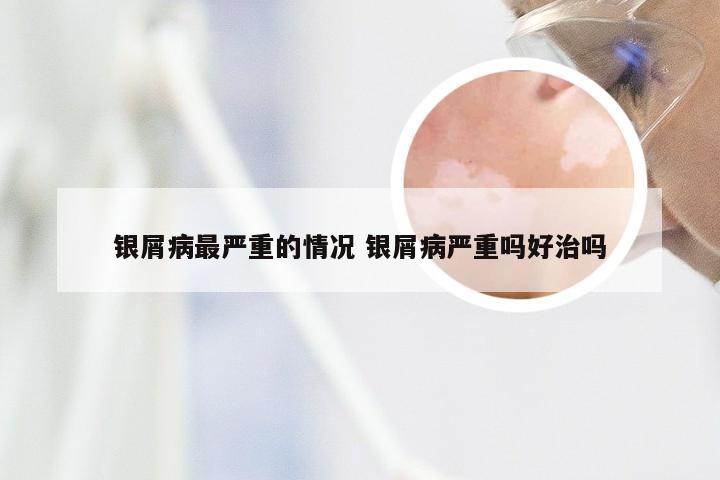 银屑病最严重的情况 银屑病严重吗好治吗