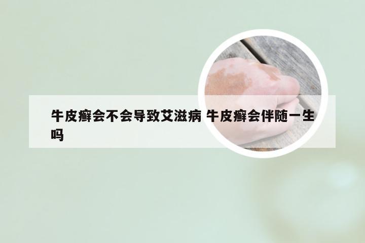 牛皮癣会不会导致艾滋病 牛皮癣会伴随一生吗