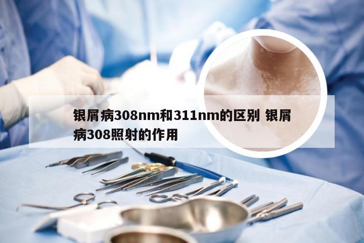 银屑病308nm和311nm的区别 银屑病308照射的作用