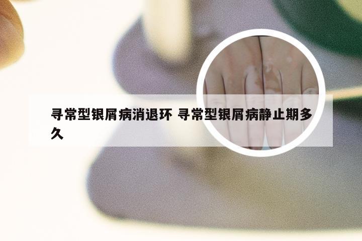 寻常型银屑病消退环 寻常型银屑病静止期多久