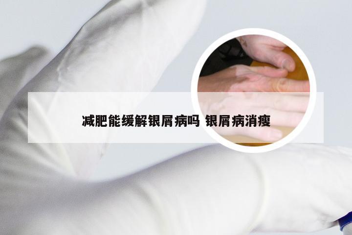 减肥能缓解银屑病吗 银屑病消瘦