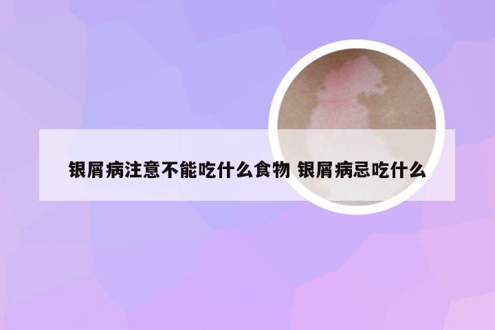 银屑病注意不能吃什么食物 银屑病忌吃什么