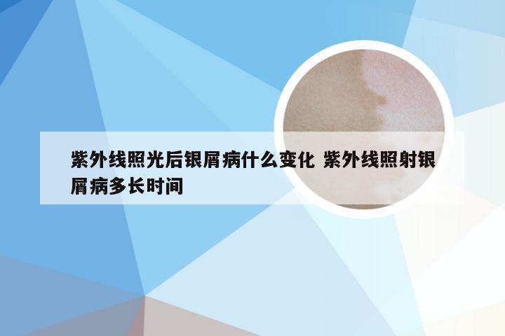 紫外线照光后银屑病什么变化 紫外线照射银屑病多长时间