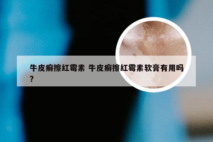 牛皮癣擦红霉素 牛皮癣擦红霉素软膏有用吗?