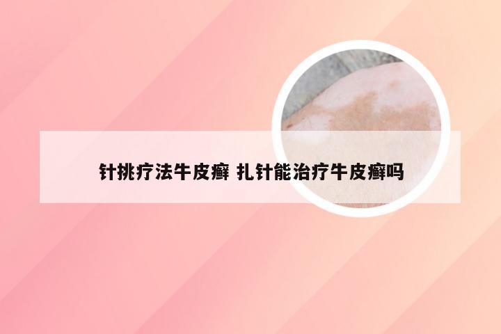 针挑疗法牛皮癣 扎针能治疗牛皮癣吗