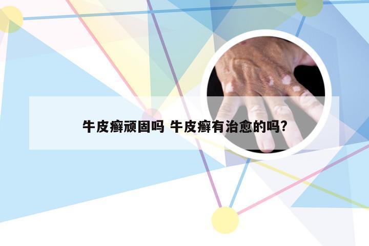 牛皮癣顽固吗 牛皮癣有治愈的吗?