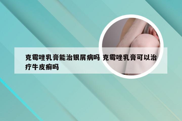 克霉唑乳膏能治银屑病吗 克霉唑乳膏可以治疗牛皮癣吗