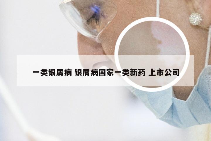一类银屑病 银屑病国家一类新药 上市公司