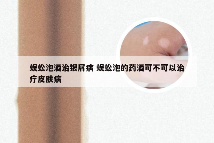 蜈蚣泡酒治银屑病 蜈蚣泡的药酒可不可以治疗皮肤病