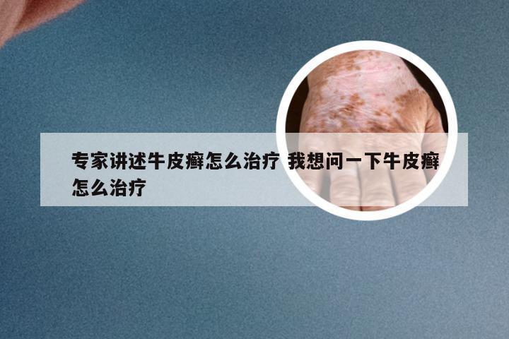 专家讲述牛皮癣怎么治疗 我想问一下牛皮癣怎么治疗