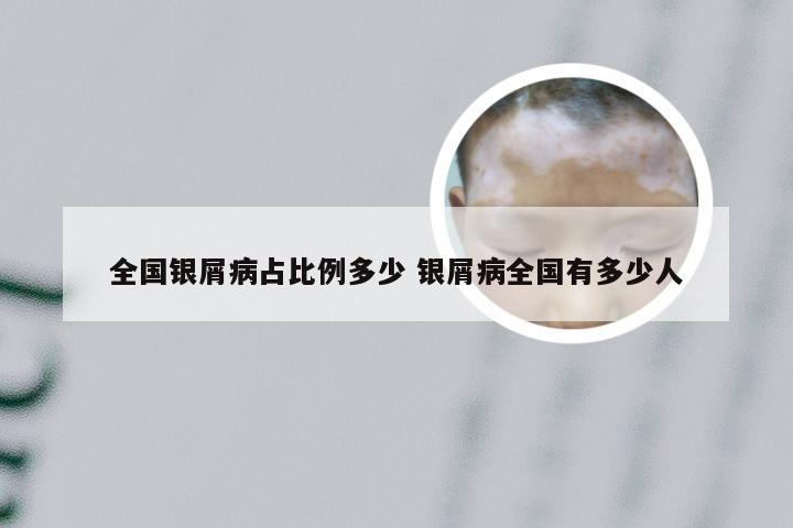全国银屑病占比例多少 银屑病全国有多少人