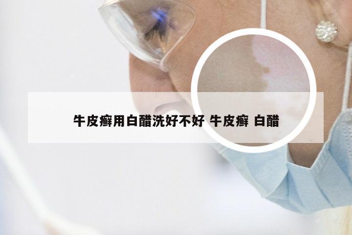 牛皮癣用白醋洗好不好 牛皮癣 白醋