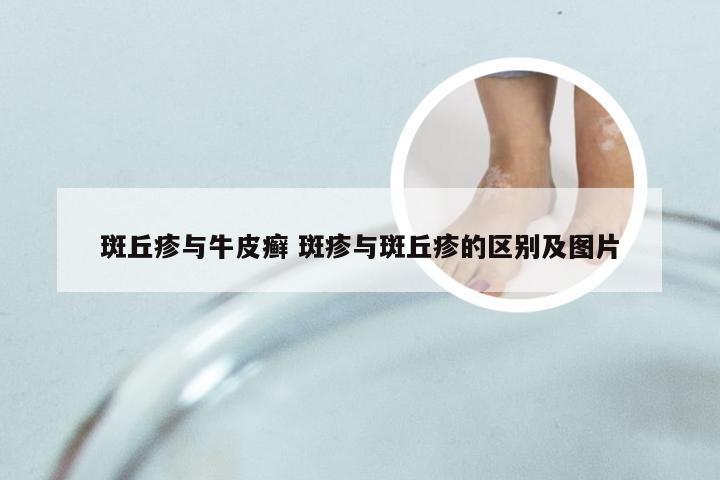 斑丘疹与牛皮癣 斑疹与斑丘疹的区别及图片