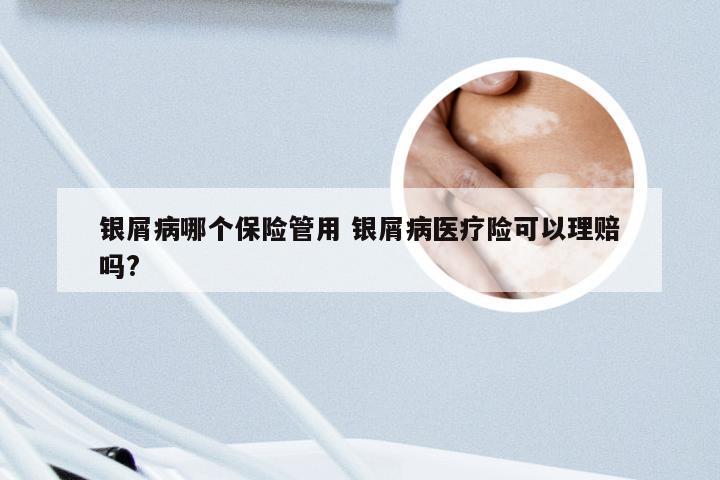 银屑病哪个保险管用 银屑病医疗险可以理赔吗?