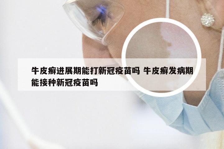 牛皮癣进展期能打新冠疫苗吗 牛皮癣发病期能接种新冠疫苗吗